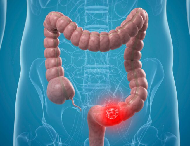 आन्द्राको क्यान्सर : के तपाईको पेट पनि बारम्बार दुखी राख्छ ? होशियार