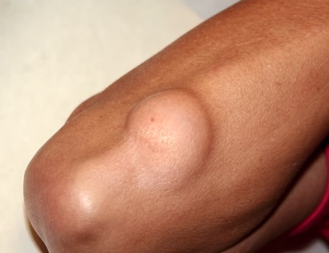 के तपाईको शरिरमा पनि सानो सानो मासुको डल्लो छ ? यस्तो हुनसक्छ कारण