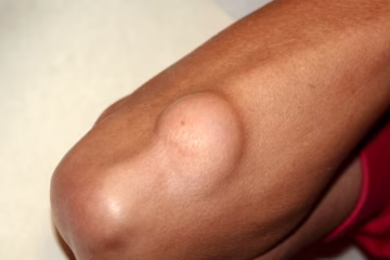 के तपाईको शरिरमा पनि सानो सानो मासुको डल्लो छ ? यस्तो हुनसक्छ कारण